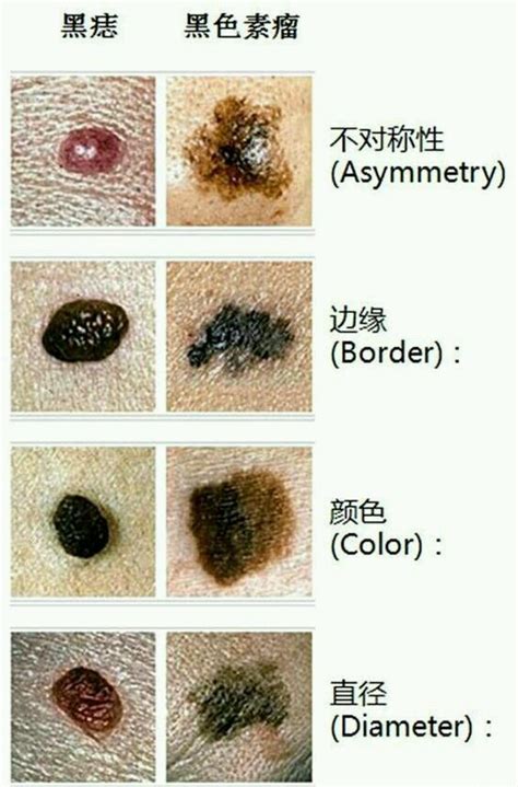 腋下有凸痣|点痣不正规可能引发癌变：关于痣的 4 个常识